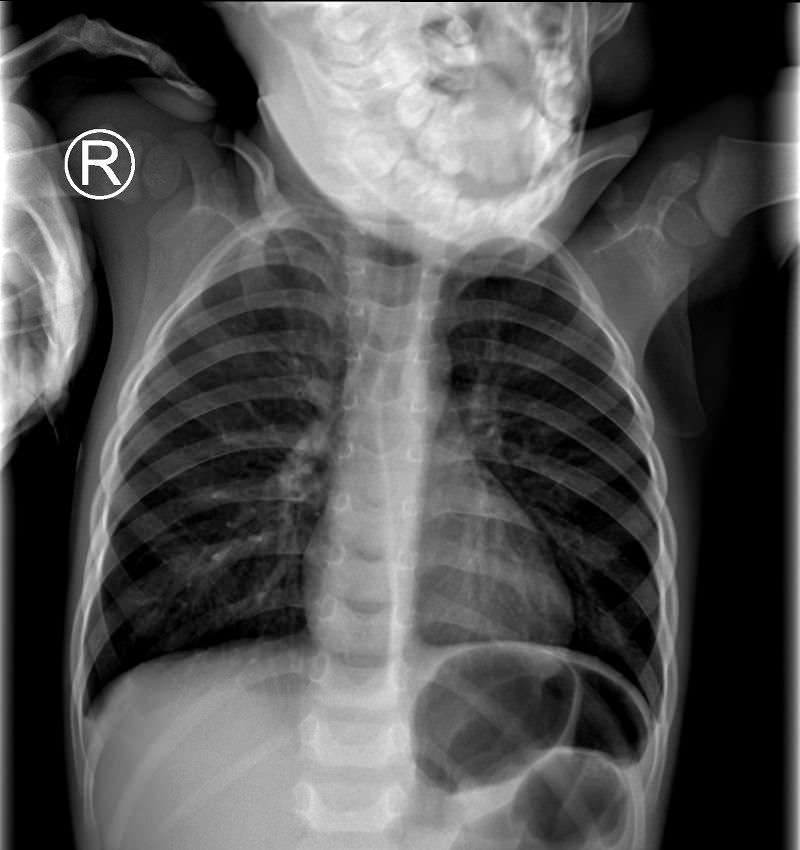 Röntgenbild von Kleinkind